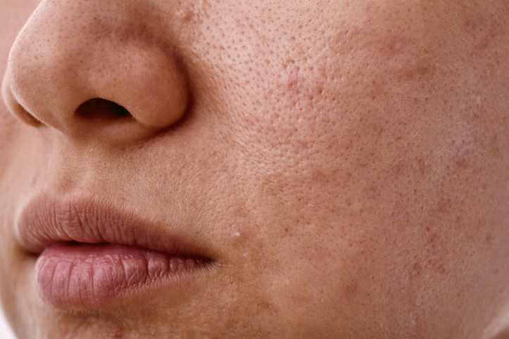 Close-up of the skin on someone's face